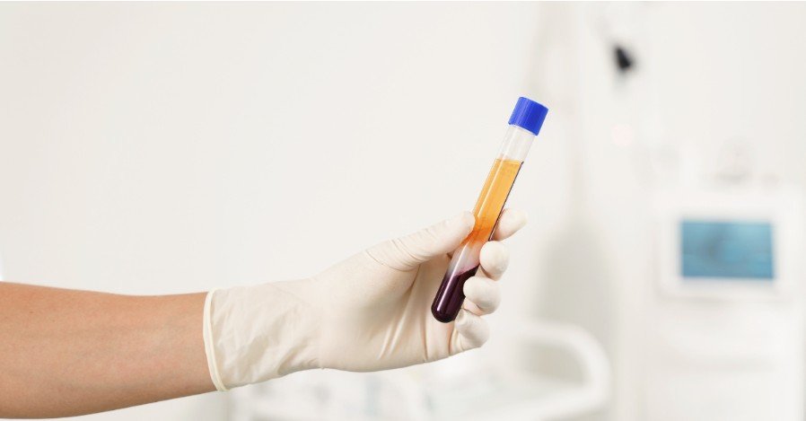 Egy kéz tart egy átlátszó kémcsövet, amelyben a vérplazma halvány sárgás színe jól látható, a háttér steril orvosi környezetet idéz.